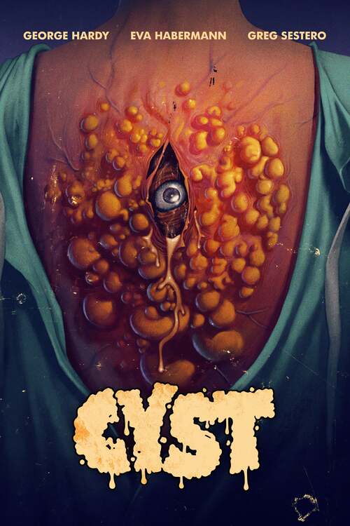 Cyst poster